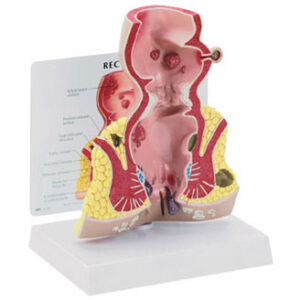 Rectum Budget Model