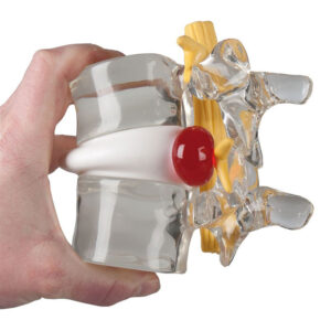 Vertebral Disc Prolapse Simulator