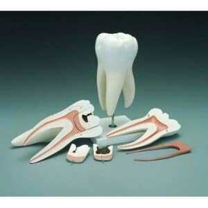 Tooth Decay Model