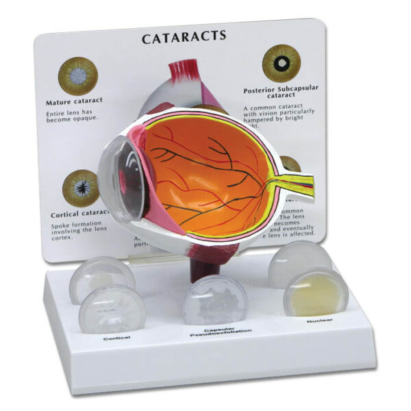 Cataract Eye - Budget Model